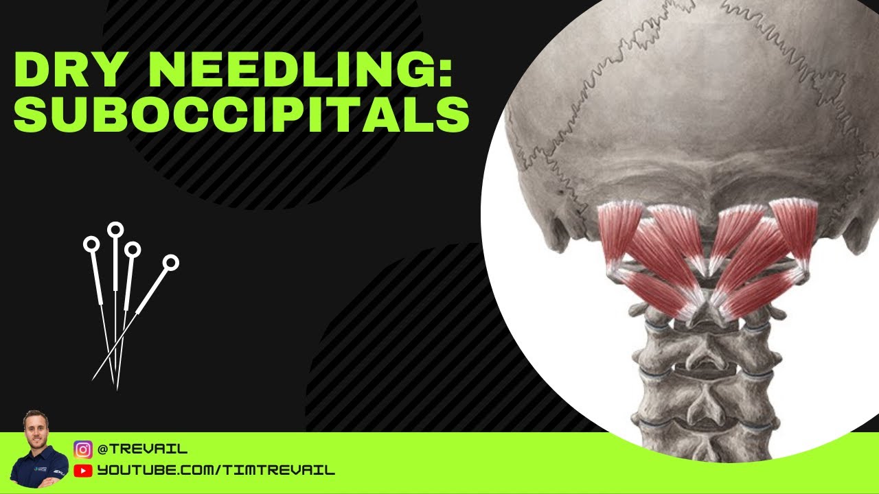 Dry Needling: Suboccipitals