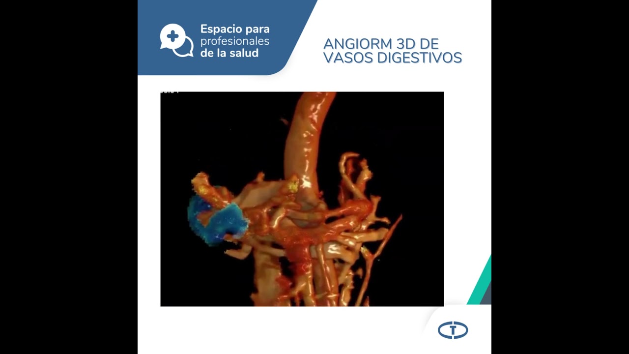 Espacio para Profesionales - Tumor de Klatzkin