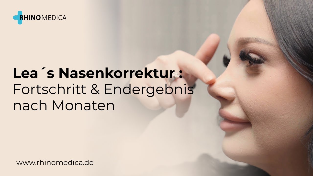 Lea`s Nasen-OP bei Rhinomedica | Ergebnisse nach 4 Monaten
