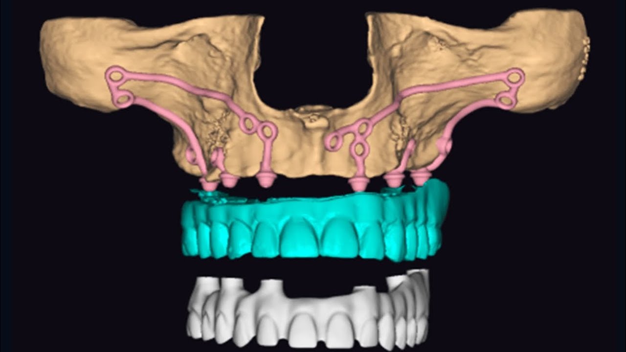 How subperiosteal dental implants are made