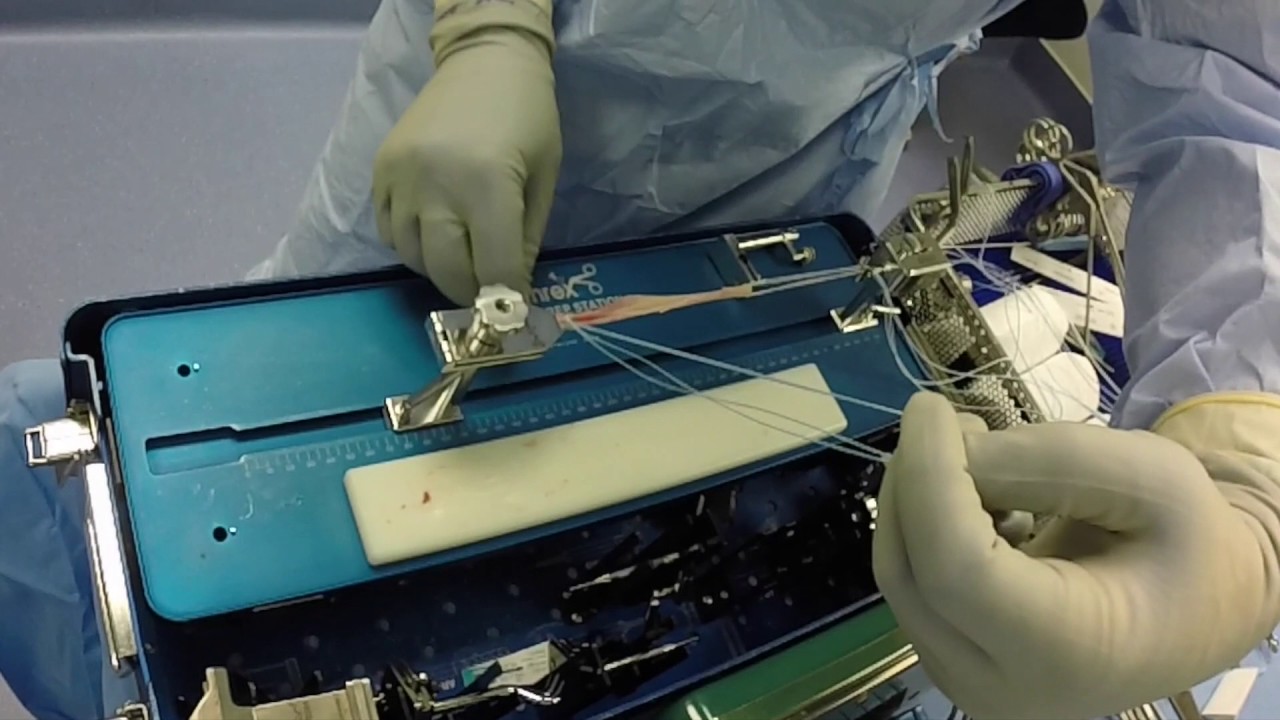Preparation of All-Inside Hamstring Autograft with Internal Brace Graft for ACL Reconstruction