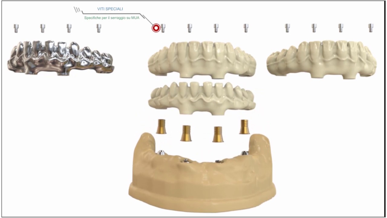LINEA GEMINI : SOLUZIONI IMPLANTARI
