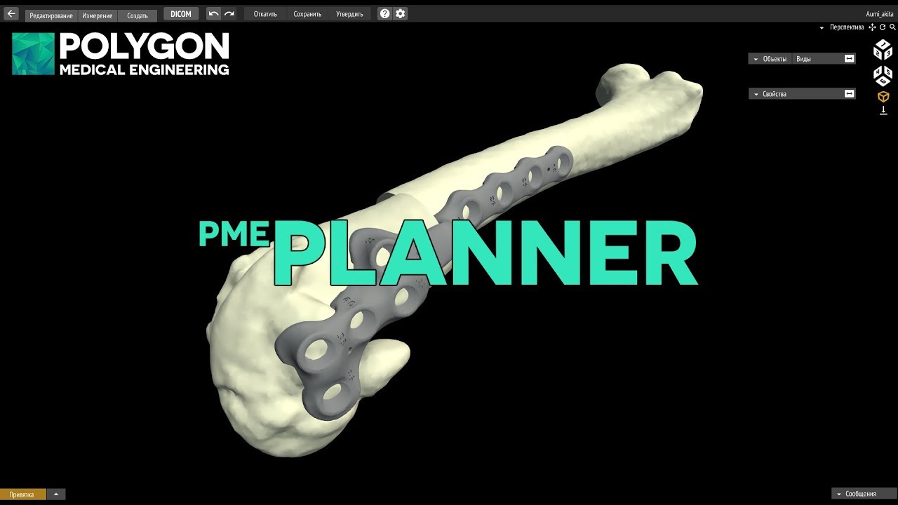 Планирование ортопедических операций с помощью PME Planner