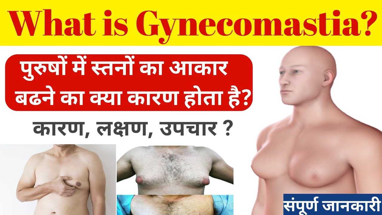 | पुरुषों में स्तनों का आकार बढ़ने का कारण और लक्षण? | What is Gynecomast and what are its symptoms?