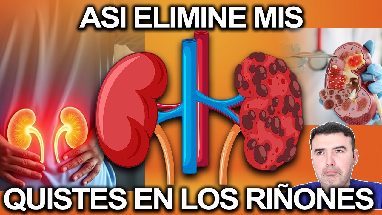 ¡Cuidado con tus Riñones La Causa #1 de los Quistes Renales que Ignoramos
