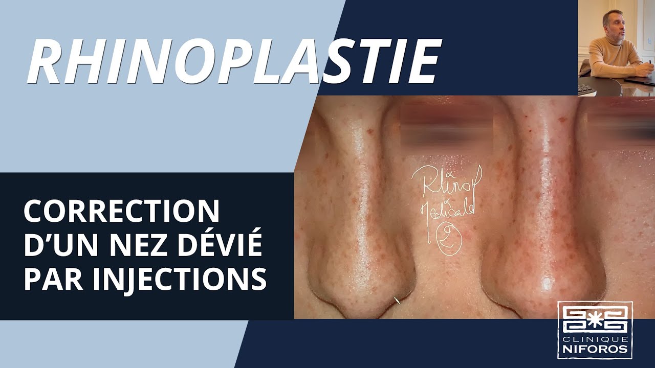 Correction d'un nez dévié par rhinoplastie médicale (injections) - Dr Niforos Lyon