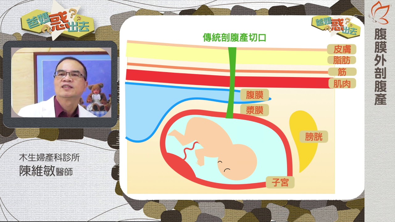 腹膜外剖腹產01：傳統剖腹產的優點及缺點（陳維敏醫師）