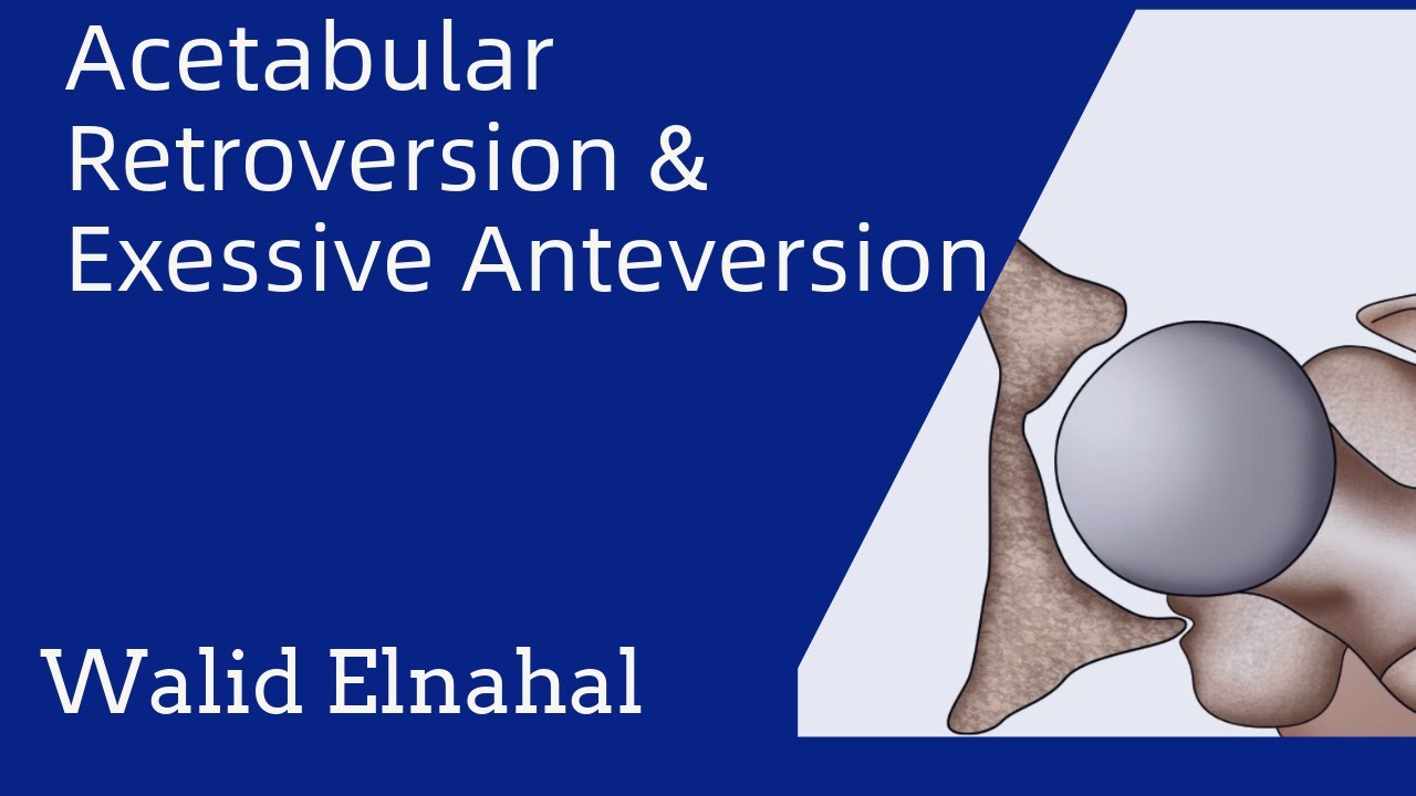 Understanding Acetabular retroversion and anteversion (Arabic ) افهم معنى انحرافات الدوران للحق