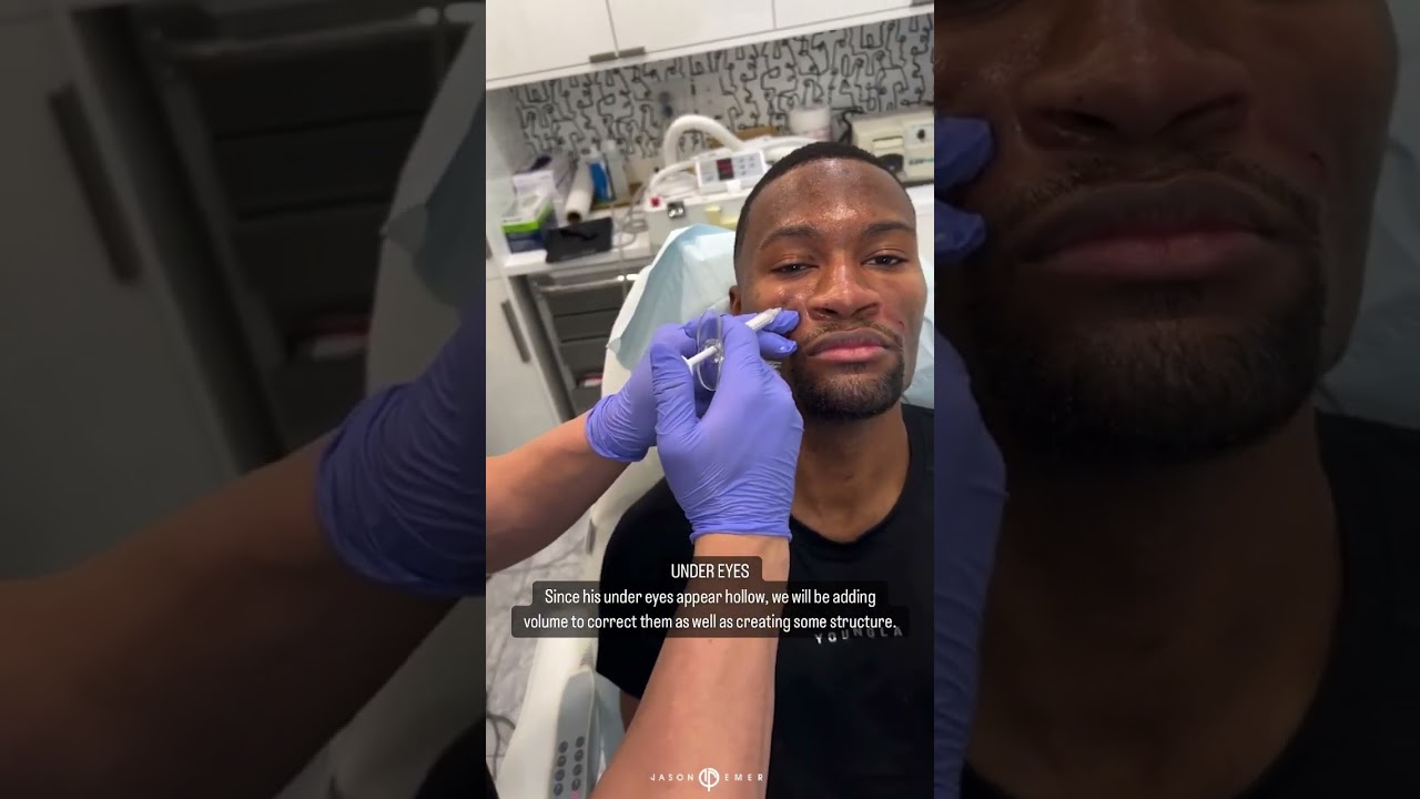 METICULOUS MASCULINIZATION | FACIAL SCULPTING
