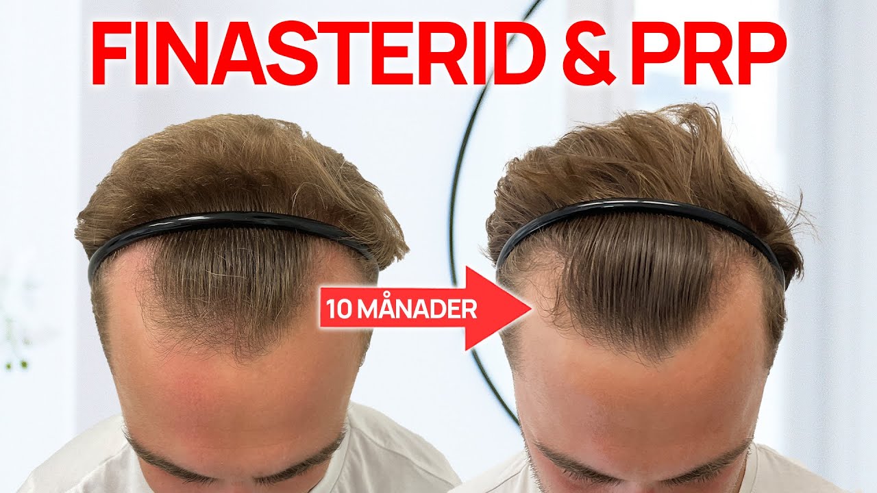 Finasterid & PRP FUNKAR mot manligt håravfall