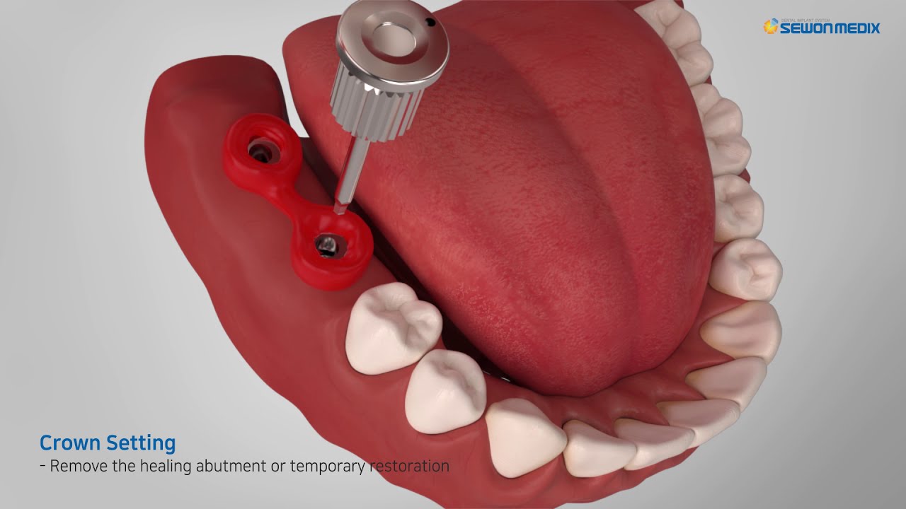 [SEWONMEDIX] FreeMilling Abutment