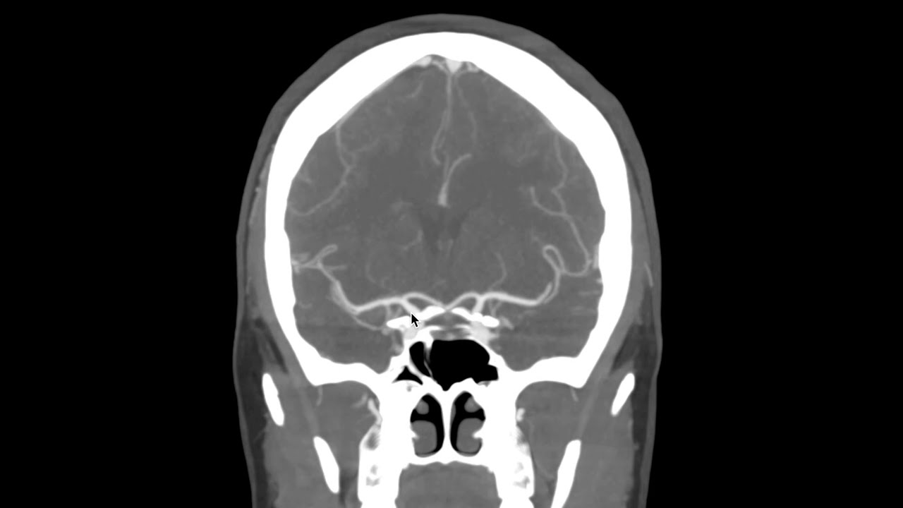 Neurovascular imaging