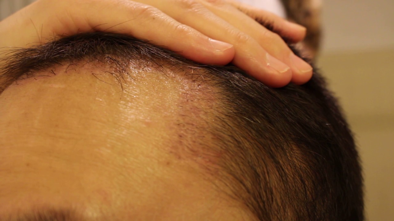 Day 55 - FUE Hair Transplant Surgery 1700 Grafts Post Op