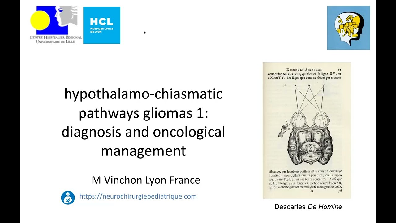 optic pathway glioma 1: oncology