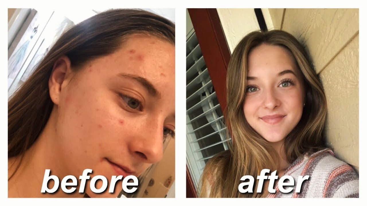 ACCUTANE FOR MILD ACNE // my story & monthly updates