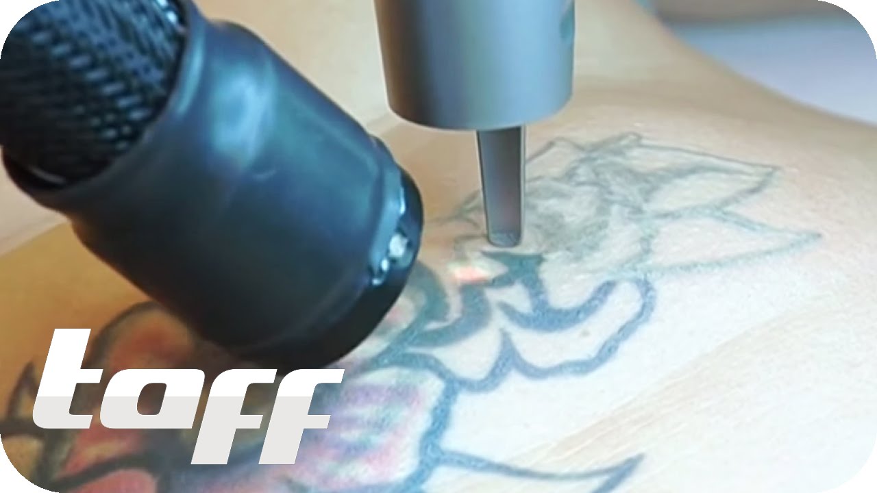 Vorher-Nachher: Jugends&uuml;nden-Tattoos entfernen | taff