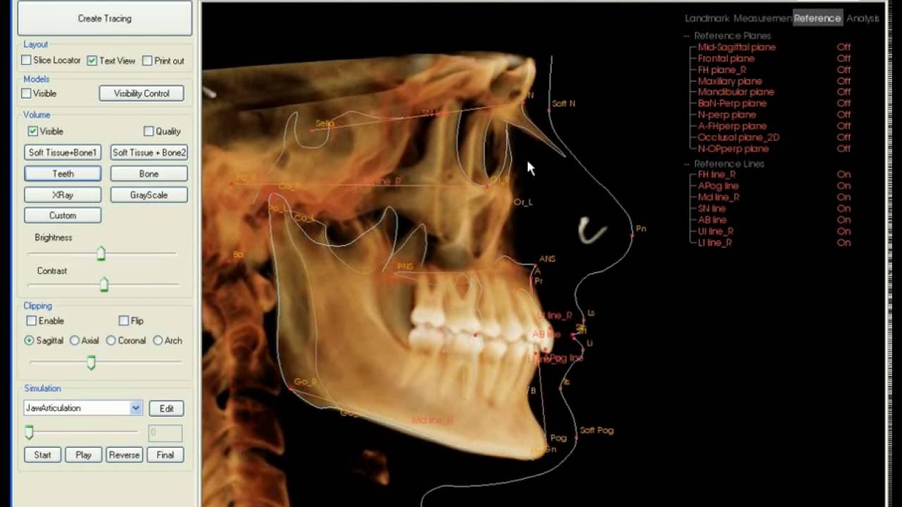 InVivo (Anatomage) 3d Cephalometric Analysis Training