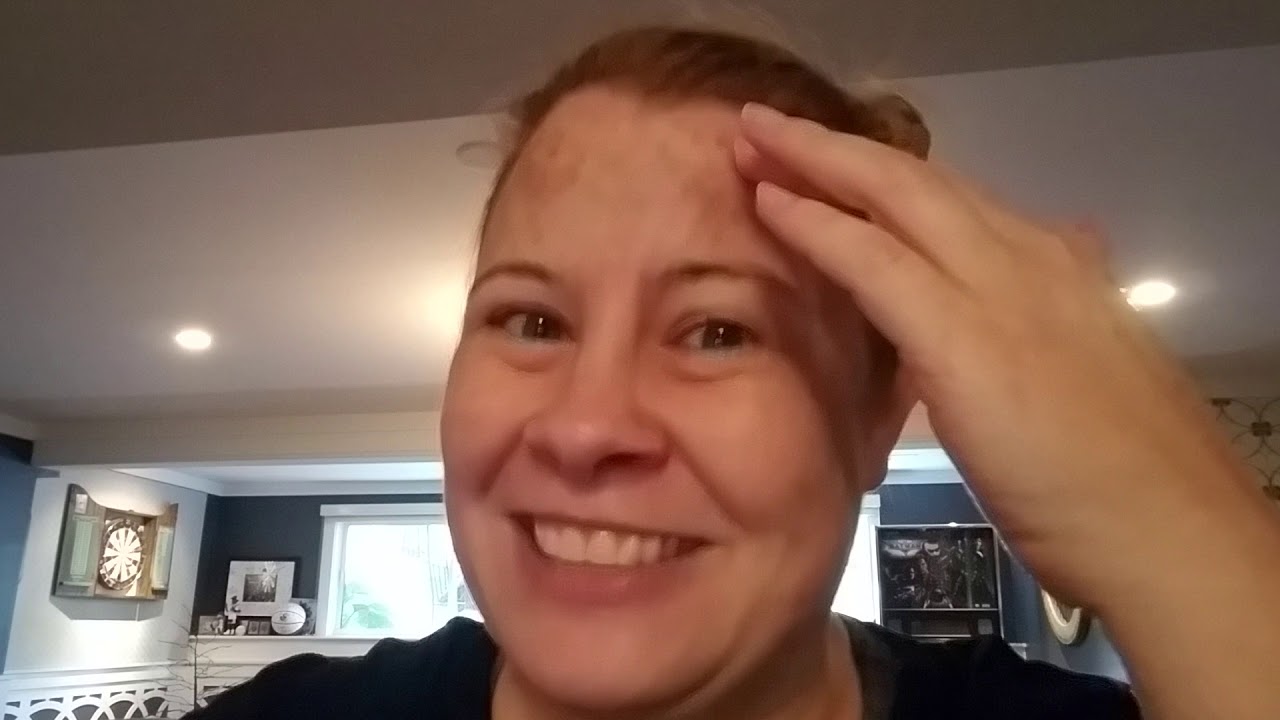 Post MVD video - 5 months post surgery
