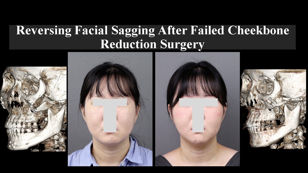 Reversing Facial Sagging After Failed Cheekbone Reduction Surgery