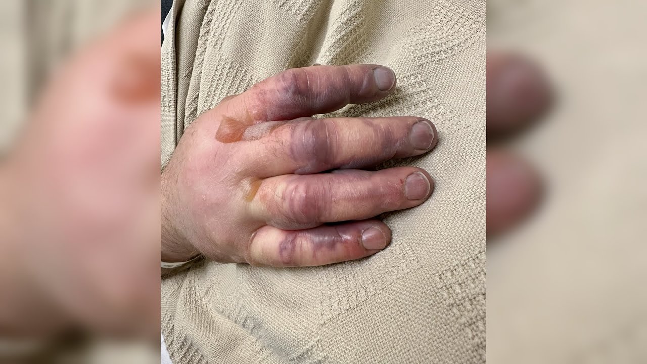 Hyperbaric Oxygen Therapy Used for Man&rsquo;s Frostbitten Fingers