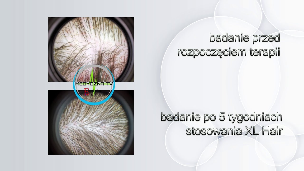 Dr n. med. Magdalena Popko: XL HAIR  - kwalifikacja i efekty po 5 tygodniach