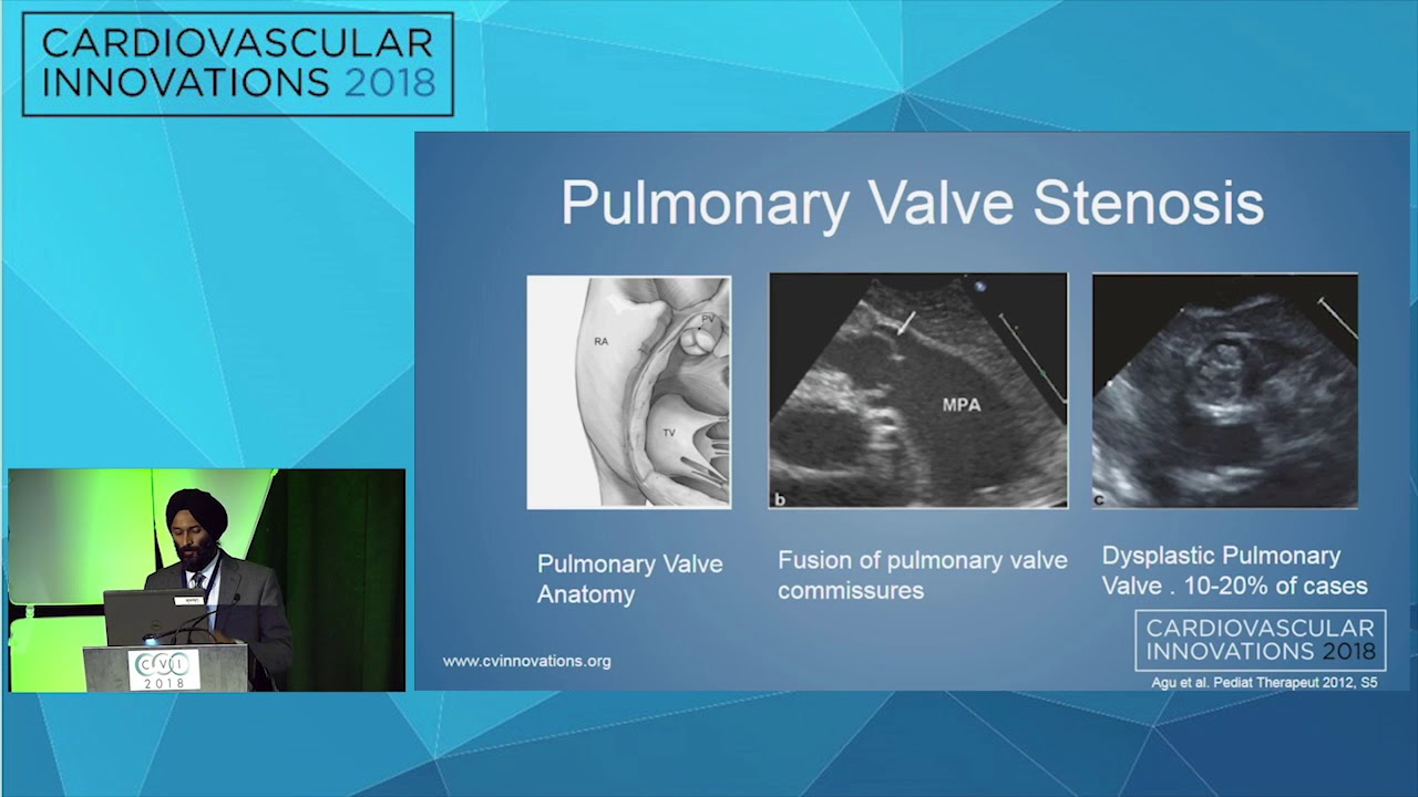 CVI2018 Session: Pulmonary Valvotomy for Severe Pulmonary Valve Stenosis - Updesh Singh Bedi MD