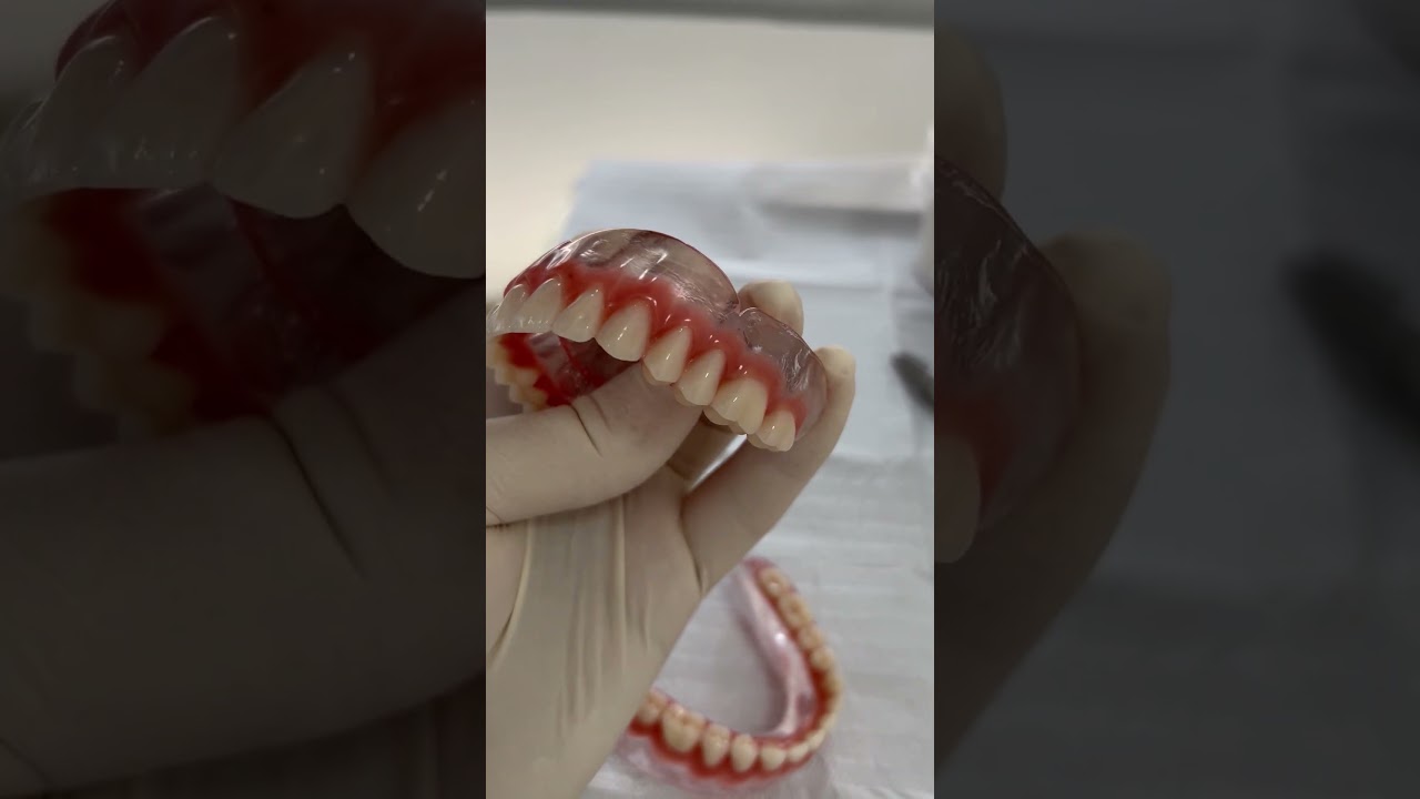 Pr&oacute;teses totais com dentes Kulzer (Alemanha)