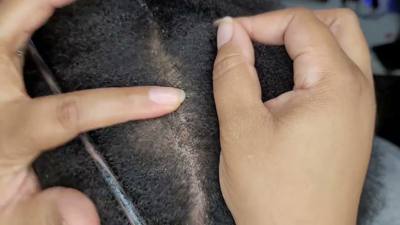 Dandruff Scratching ASMR Picking Flakes Scalp Check