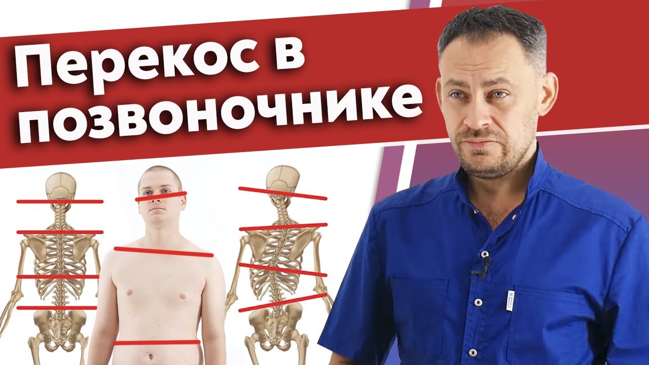 Что такое сколиоз позвоночника? / Какие последствия будут, если не лечить перекос позвоночника?