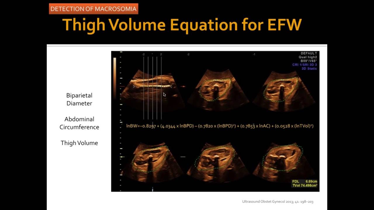 AIUM Webinar: Evaluating the Fetus at Risk for Shoulder Dystocia