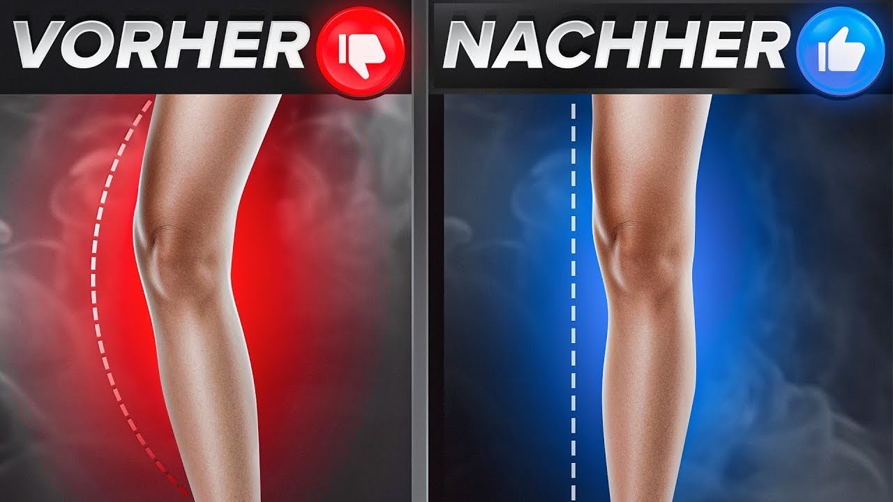 X-Beine korrigieren (Knie kollabieren nach Innen + Schmerzen)