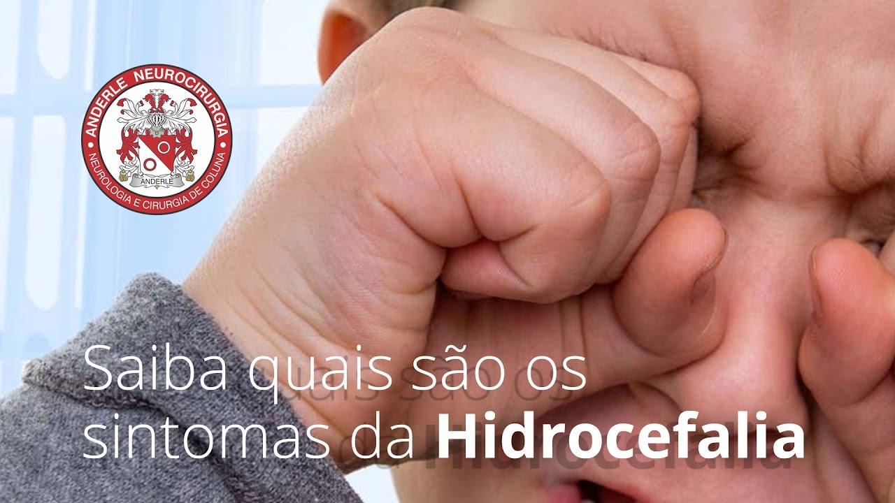 Saiba quais são os SINTOMAS da Hidrocefalia - Dr Diogo Neurocirurgião