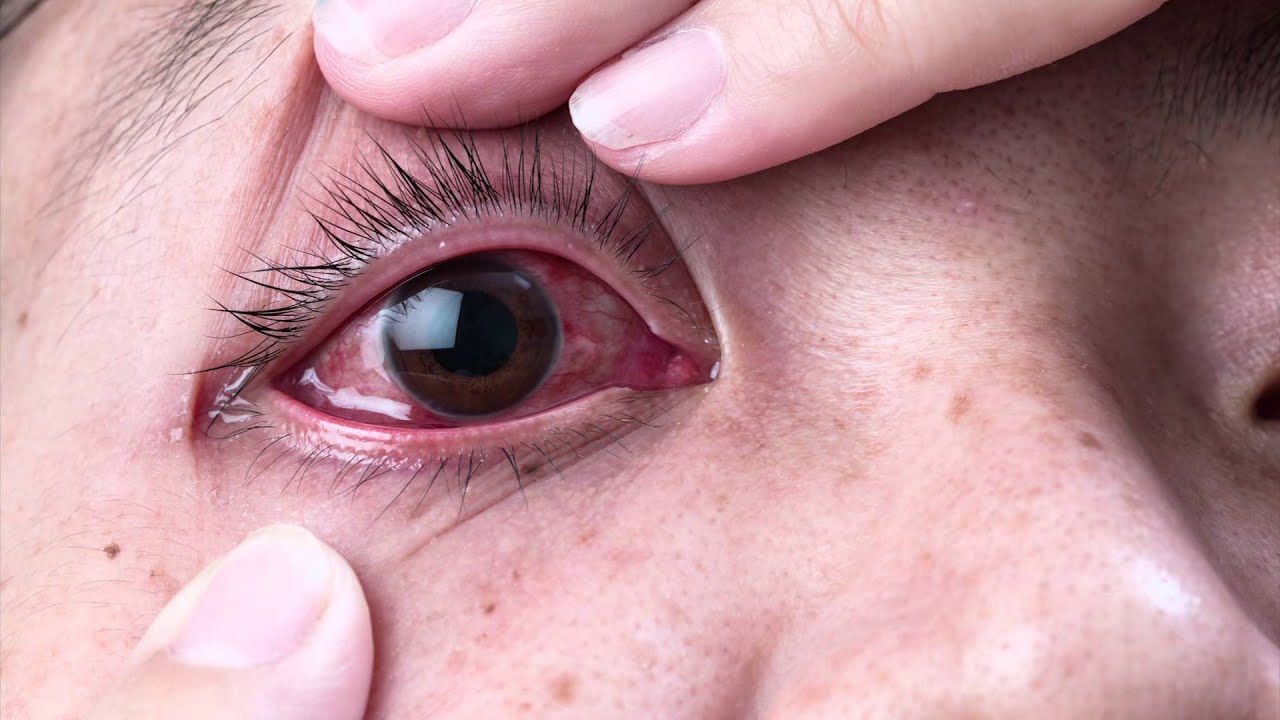 Ask The Expert - Dr. Gabriel Sosne - Pink Eye and Viral Eye Infections