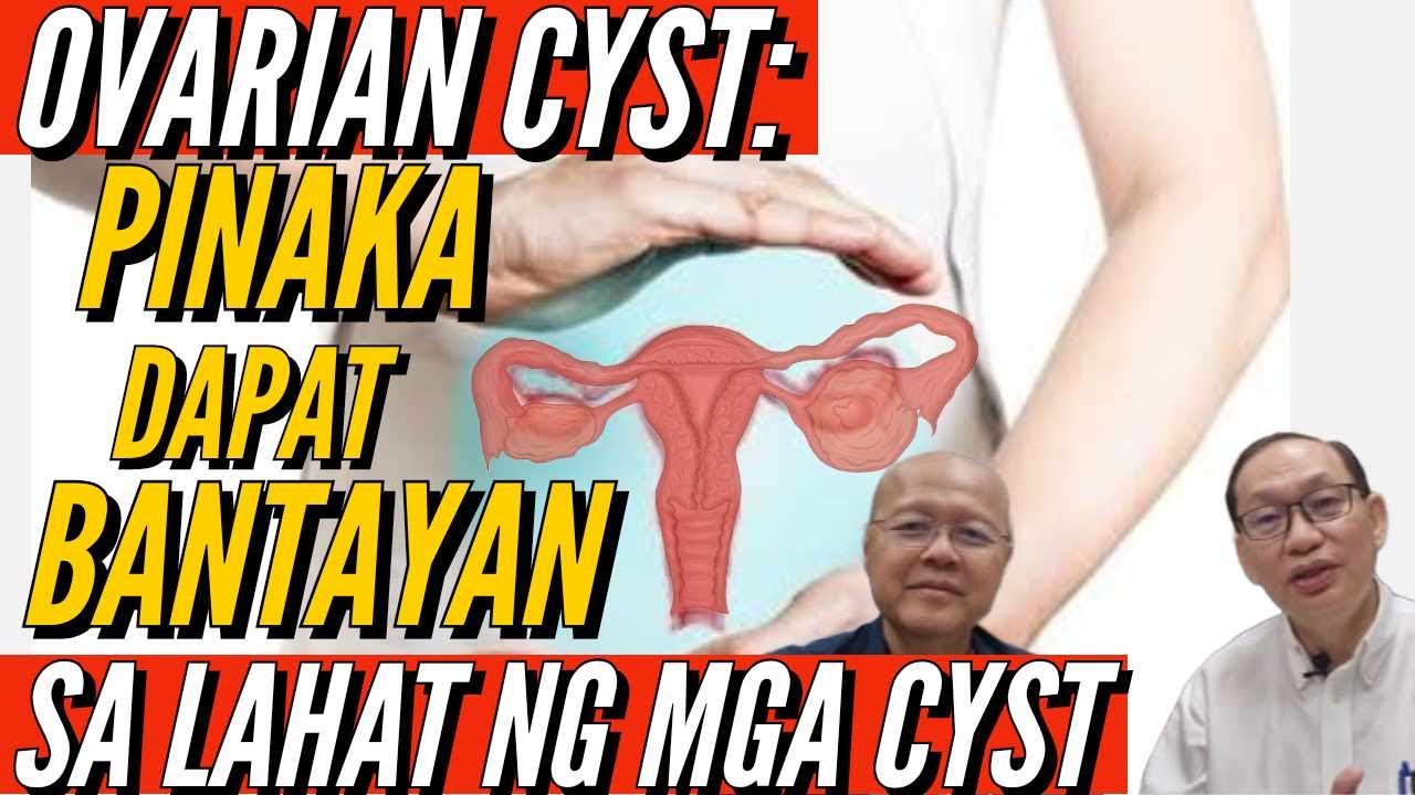 Ovarian Cyst: Pinaka Dapat Bantayan na Cyst