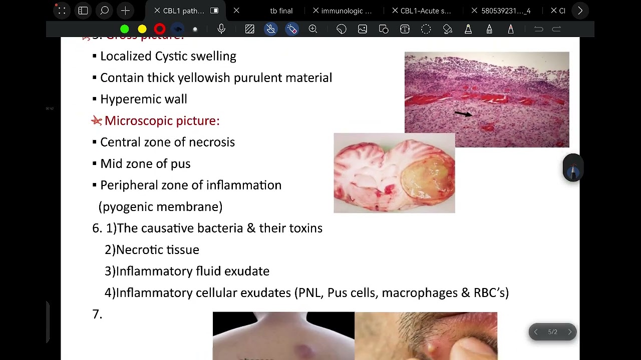 CBL1 _ acute suppurative inflammation of skin 