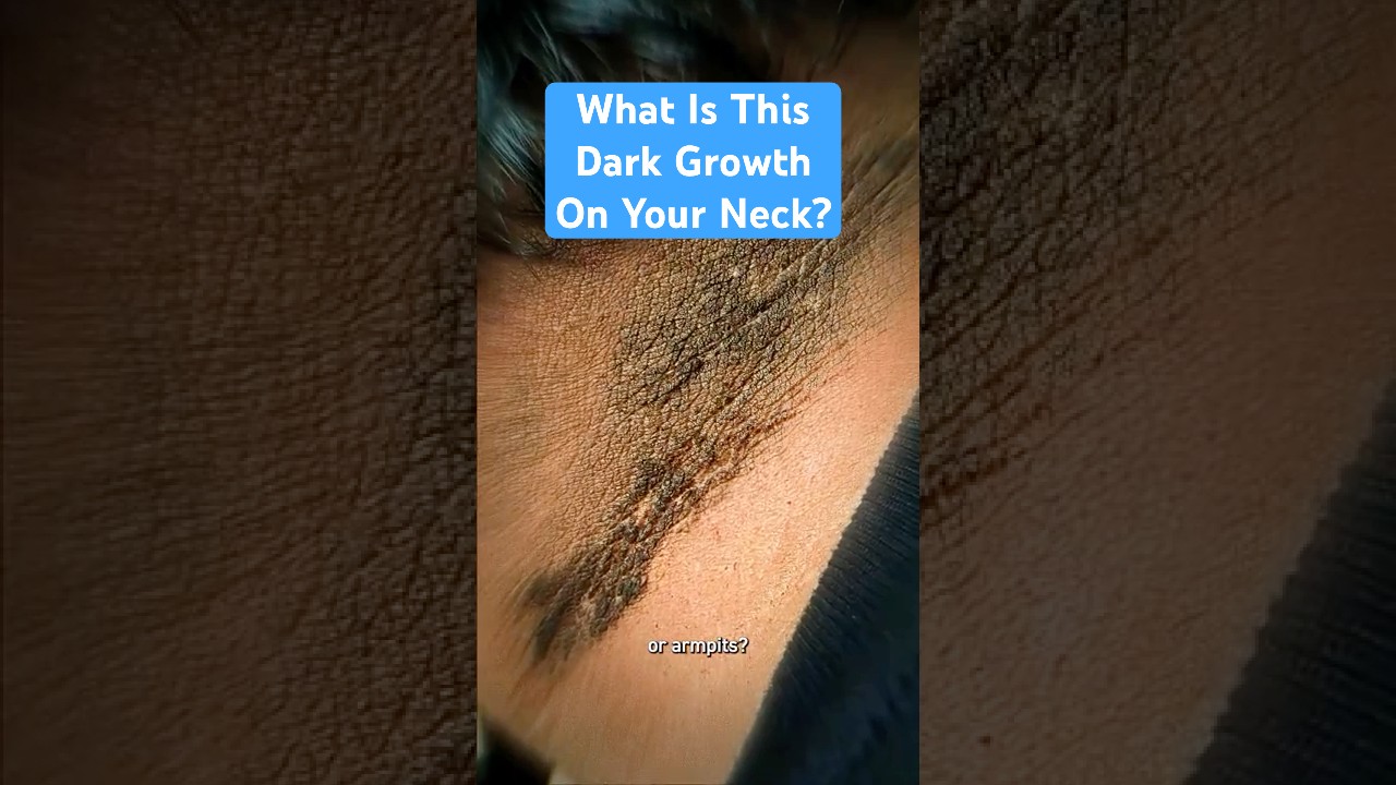 What is this dark growth on your neck?