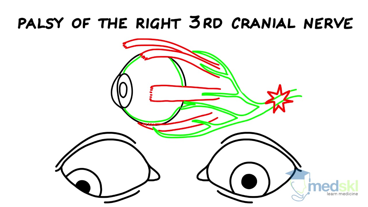 Ophthalmology – Strabismus: By Yi Ning Strube M.D.
