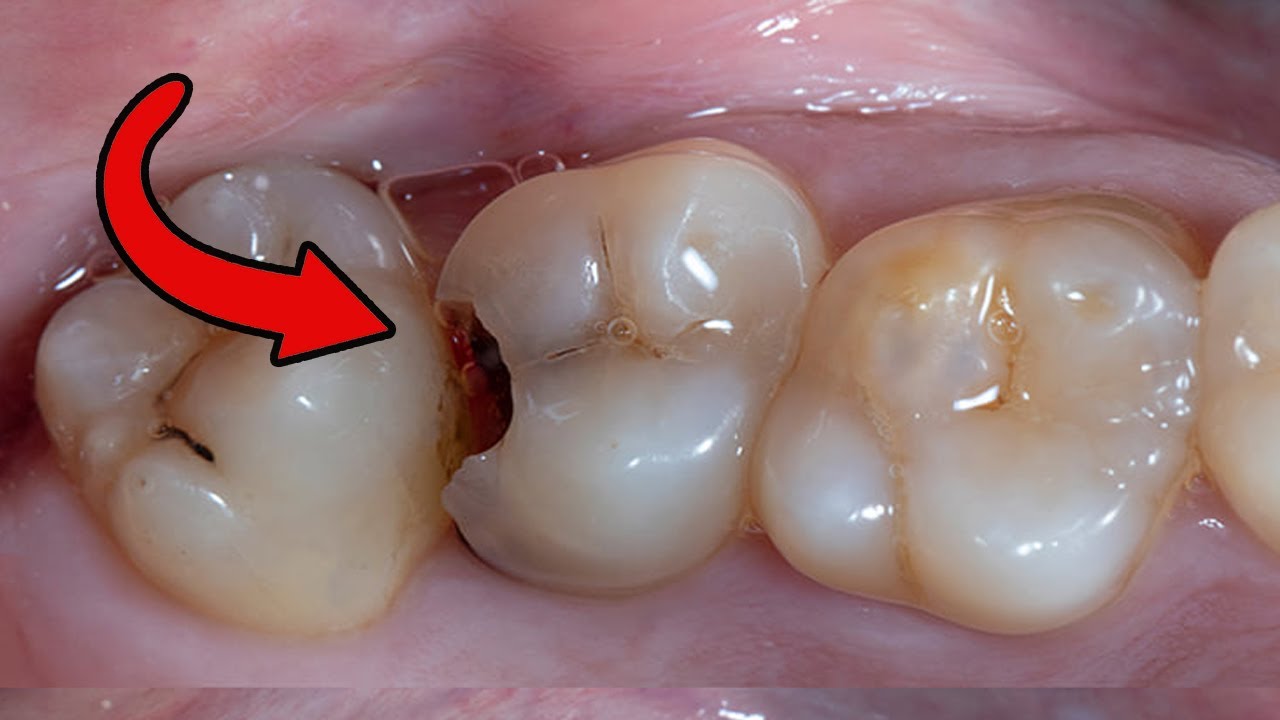 Các bước trám răng | step by step posterior composite filling