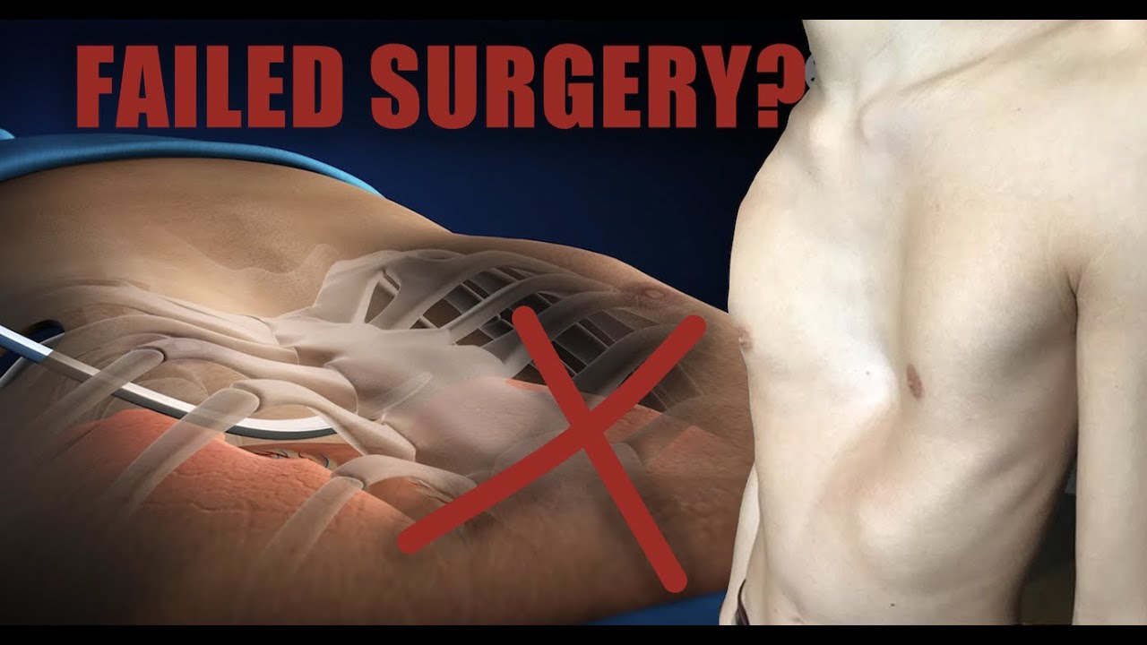 FAILED NUSS PROCEDURE (What to do Next?) Pectus Excavatum Surgery