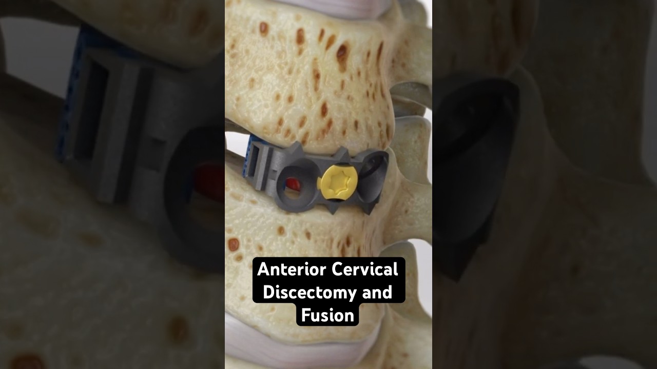 Using bone mush to fuse a damaged disc (3D Animation)