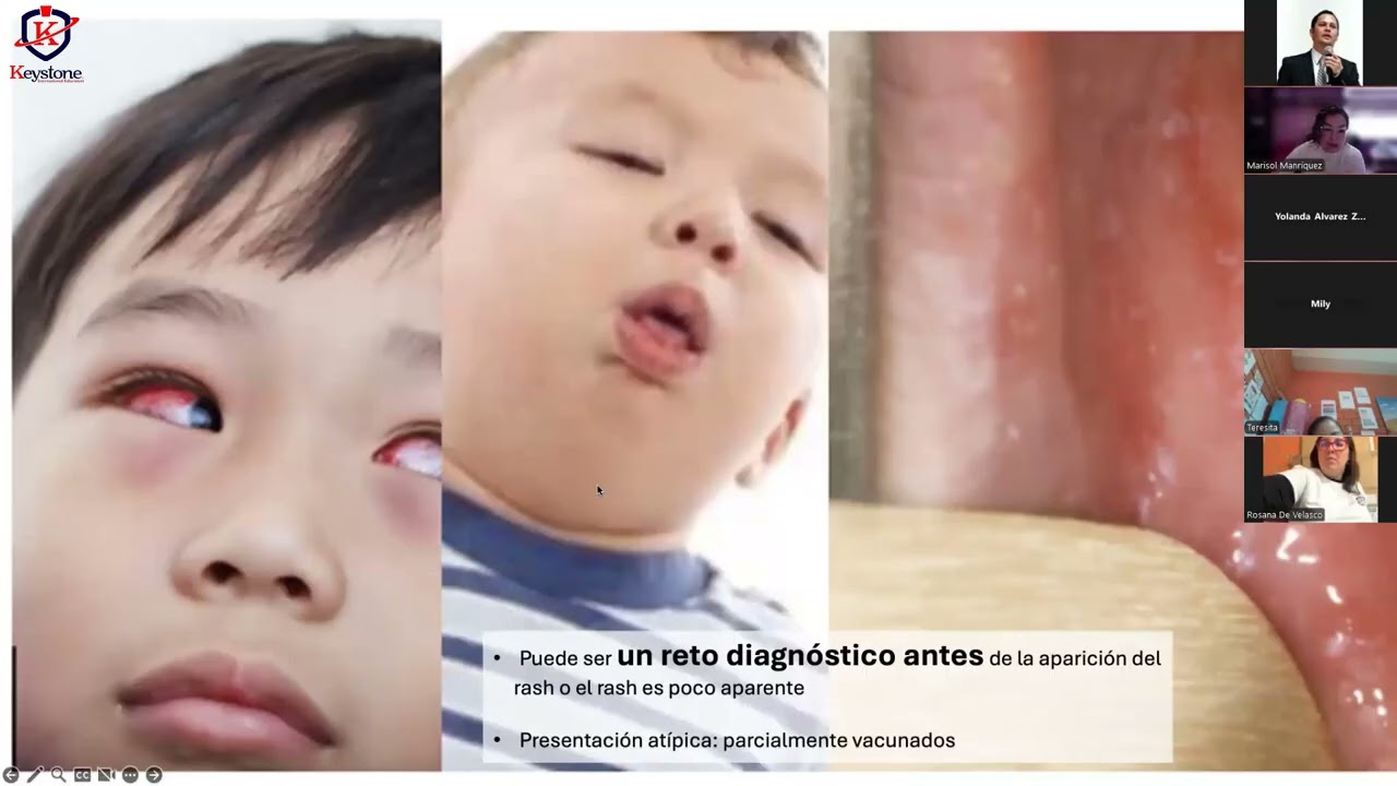 Lo que debemos Saber del Sarampión - Keystone
