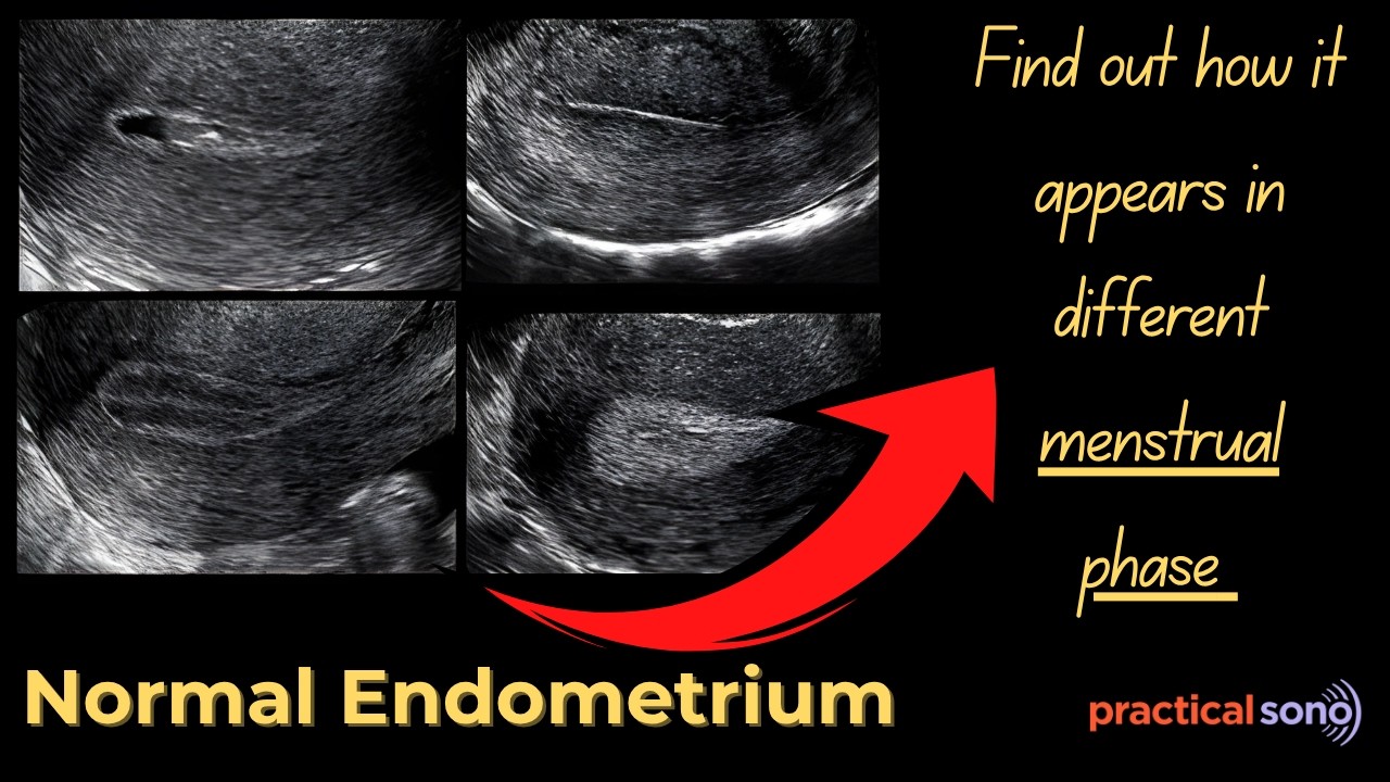 Understanding Endometrium Thickness Ultrasound During Menstrual Cycle