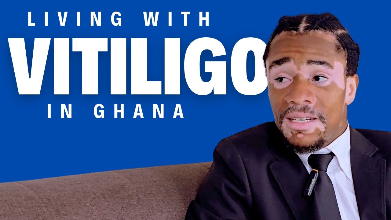 How A Skin Condition Changed His Life | A Ghanaian Man’s Story
