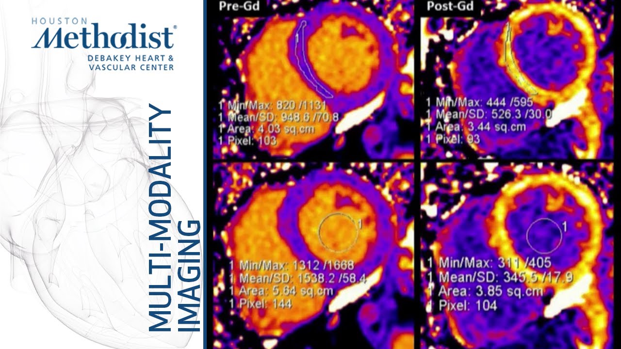 Mitral and Aortic Stenosis: Evaluation by Echo & CMR (Zoghbi, MD, and Nabi, MD) November 12, 2019