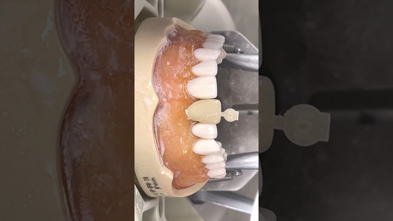 Adjustment of polycarbonate crown form before relining