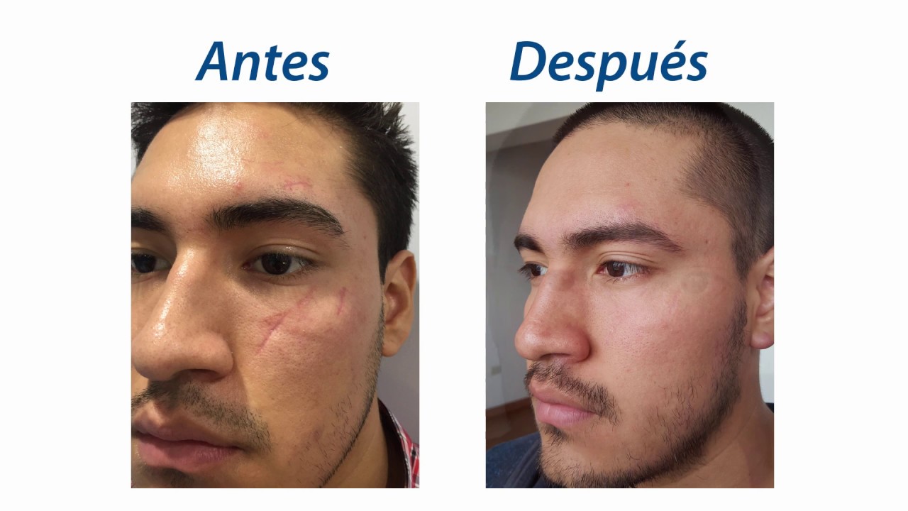 Tratamiento para cicatrices en rostro con láser de CO2 fraccionado - Testimonio de paciente