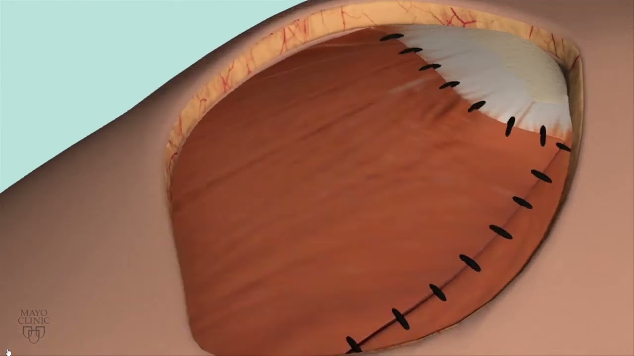 Video  Transferencia de tendón para reparar el manguito de los rotadores   Mayo Clinic   Brave 2023
