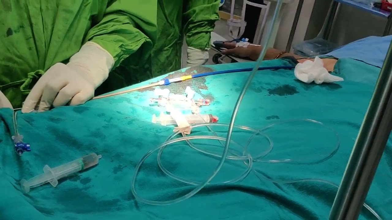 ASD closure by Amplatzer Device Prof Dr Vivek Gupta Senior Cardiologist Apollo hospital 8.8.2022