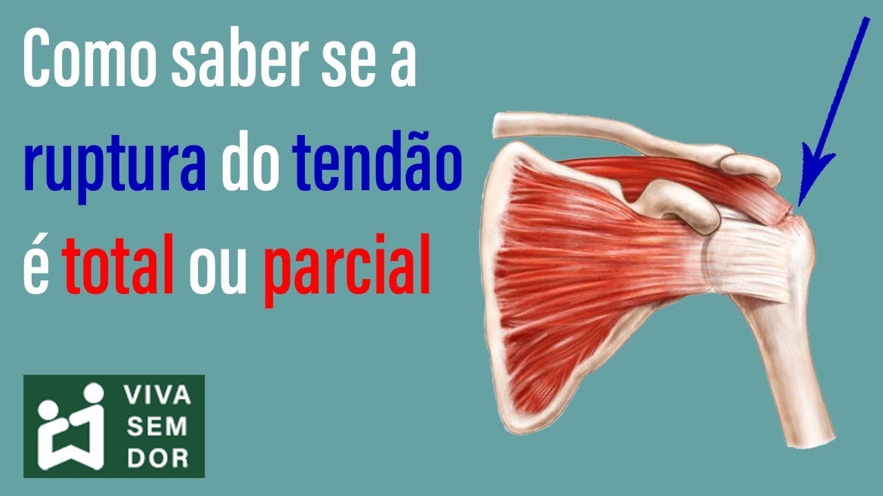 Como saber se a ruptura do tendão é total ou parcial