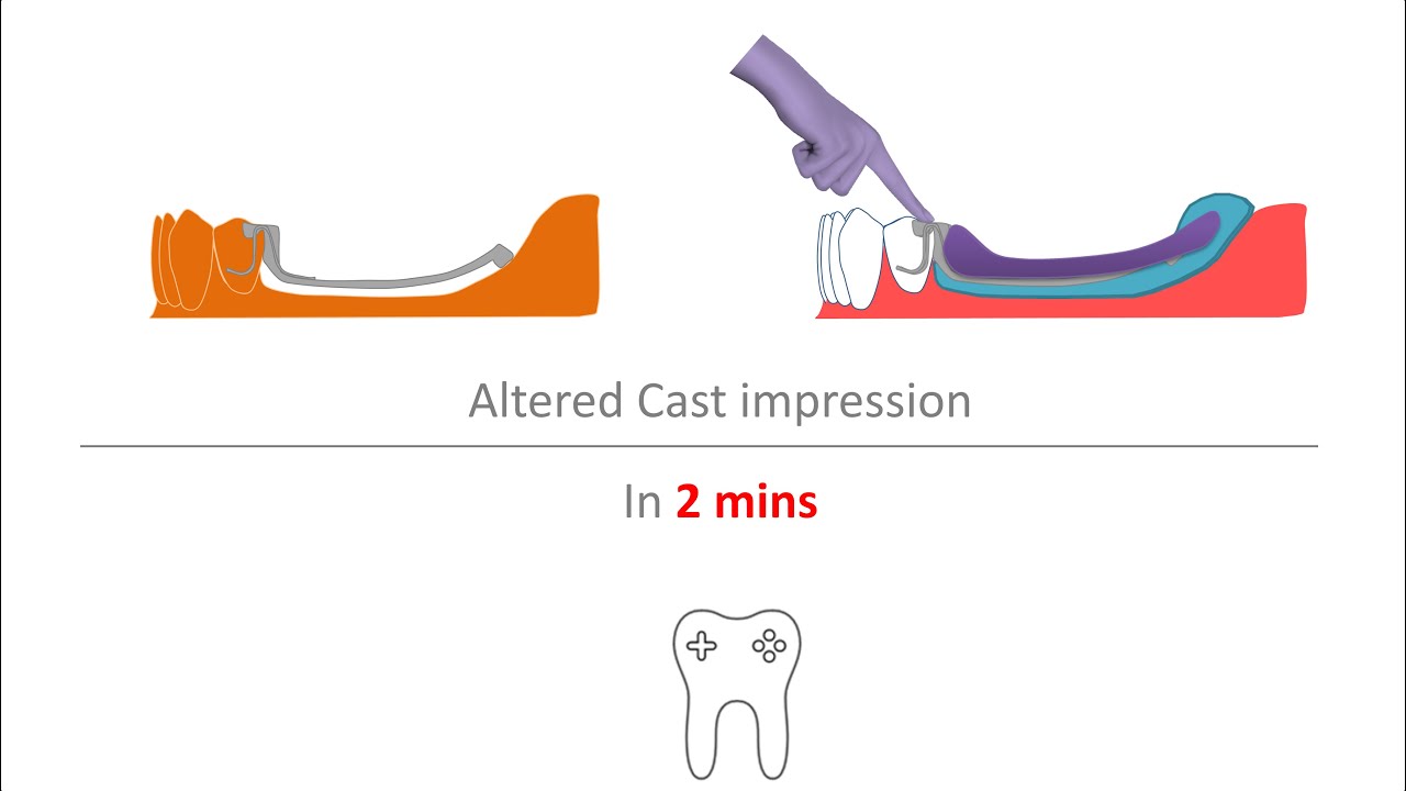 RPD Altered Cast Impression in 2 mins